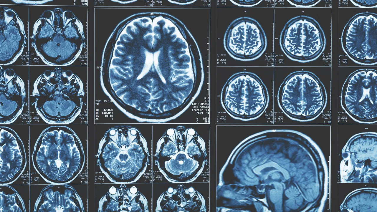 Washington Üniversitesi'nden Alzheimer Araştırması: Beynin Dışındaki Lenf Düğümleri Bağışıklık Yanıtını Yönlendiriyor