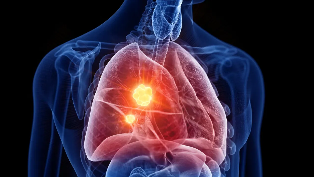 Yeni Mesotelyoma İlacı PRX3'i Hedef Alarak Kanser Hücrelerini Yok Ediyor